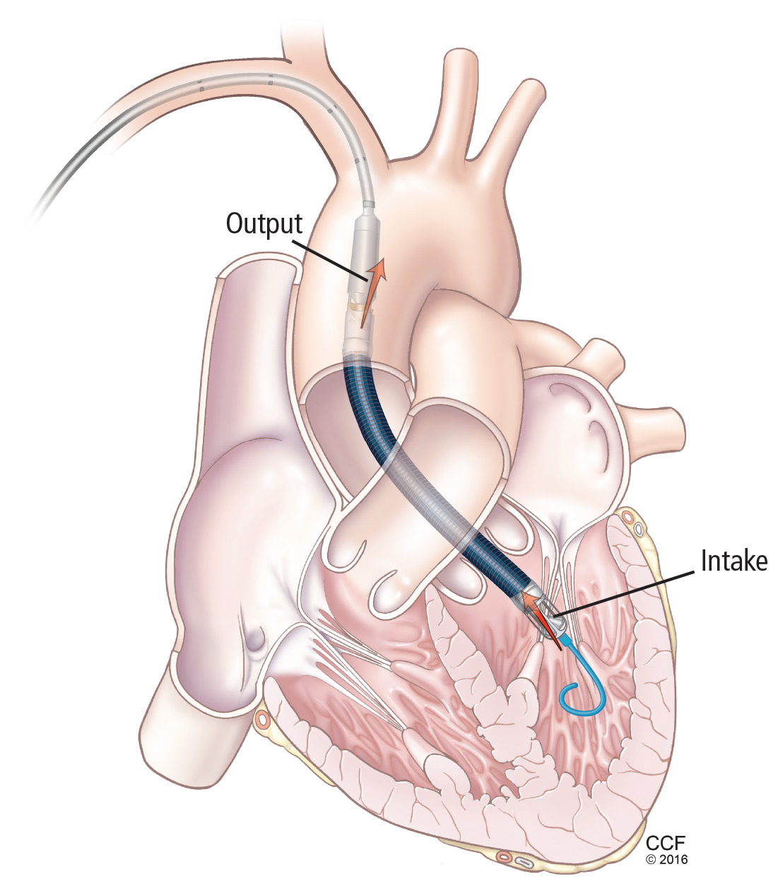 IMPELLA IS YET TO OUTSCORE THE INTRA-AORTIC BALLOON PUMP IN SEVERE ...